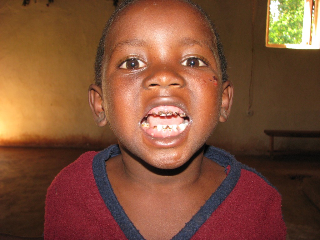 Bad teeth